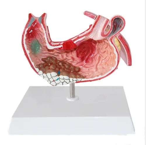 KKI-D021D Diseased Stomach Model