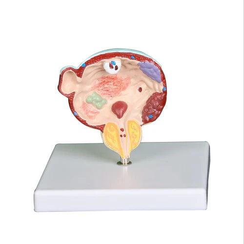 KKI-U034 diseased Bladder and Prostate Model