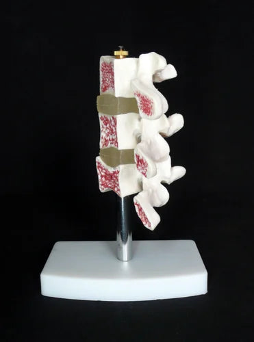 Vertebrae Osteoporosis Anatomical Model