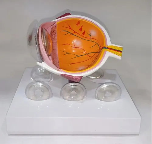 Cataract Disease Eye Model