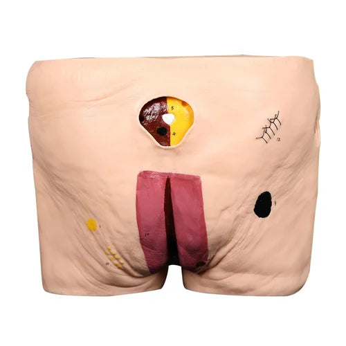 Decubitus Ulcer Care Model