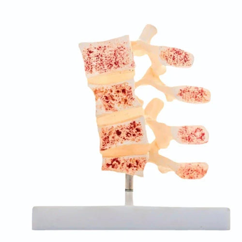 Kay Kay Osteoporosis Vertebrae Model